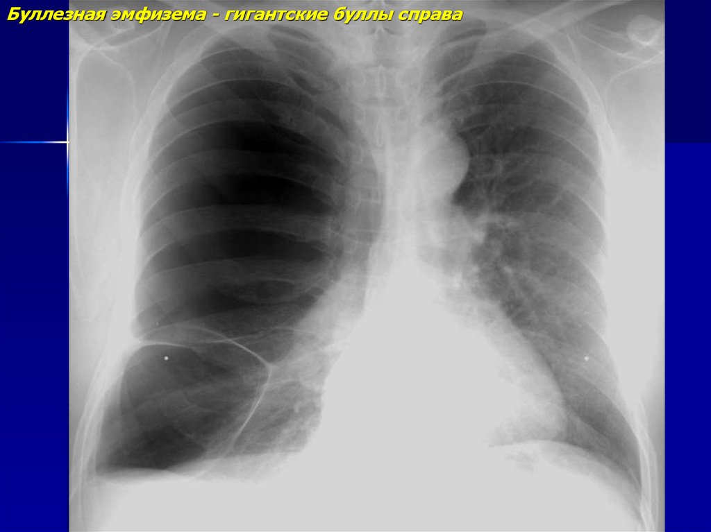 Буллы в легких что это такое. Буллезная эмфизема легкого рентген. Буллезная эмфизема рентген.
