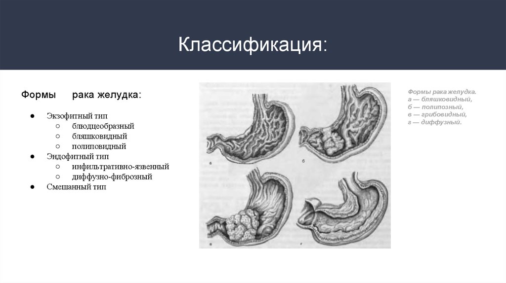 Рак желудка рисунок