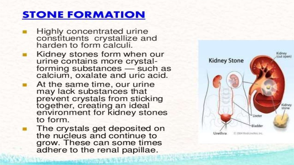 Kidney stone перевод