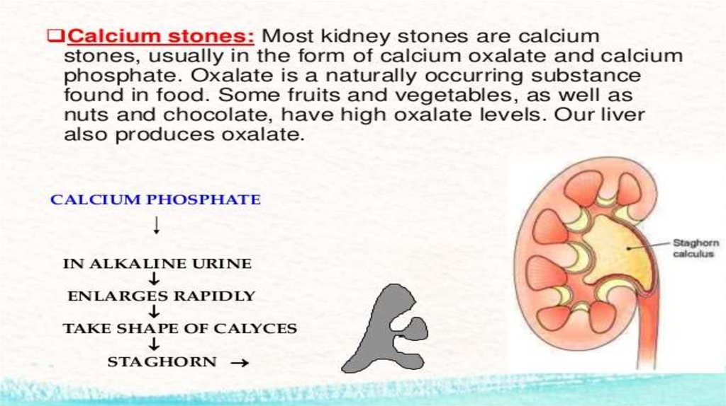 Kidney stone перевод