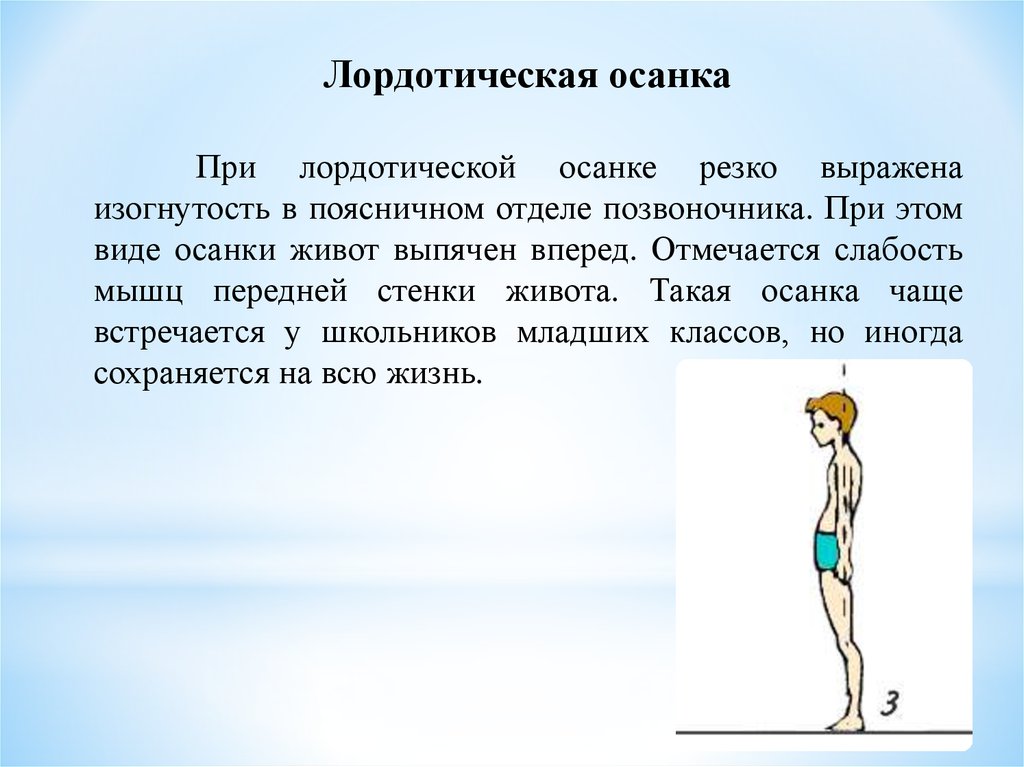 Координация осанки. Лордотическая осанка. Признаки лордотической осанки. Лордотическая осанка характеризуется. Нарушение осанки болезни.