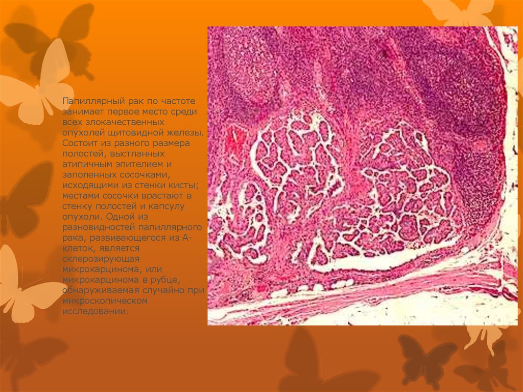 Опухоль железа. Папиллярная микрокарцинома щитовидной. Папиллярная карцинома гистология. Папиллярная карцинома щитовидной железы гистология. Папиллярная аденокарцинома щитовидной железы гистология.