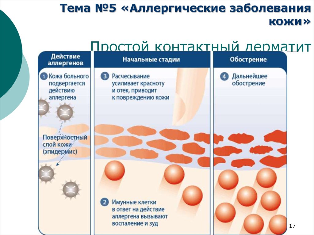 Аллергический контактный дерматит презентация