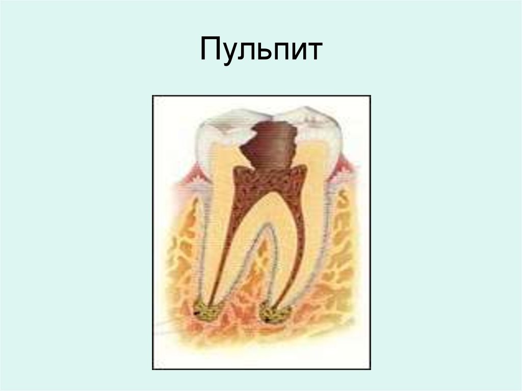 Пульпит у детей. Строение зуба кариес пульпит. Острый очаговый пульпит временных зубов.