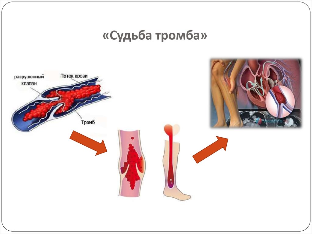 Посттромбофлебитический синдром презентация