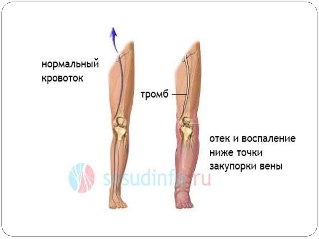 Посттромбофлебитический синдром презентация