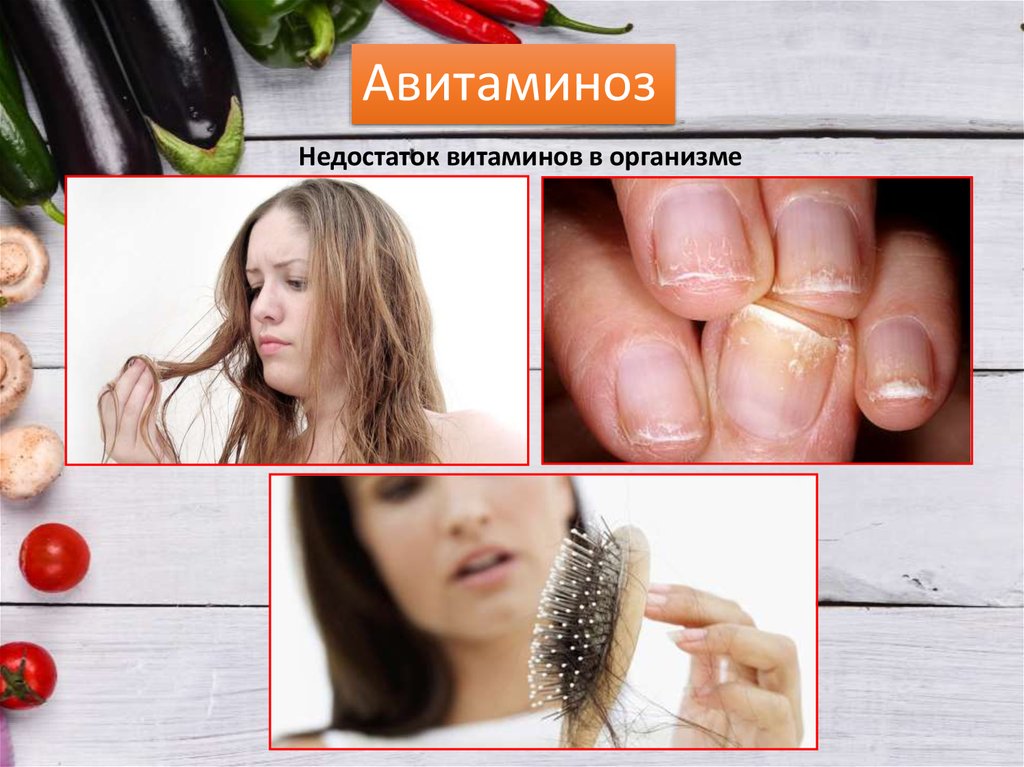 Авитаминоз