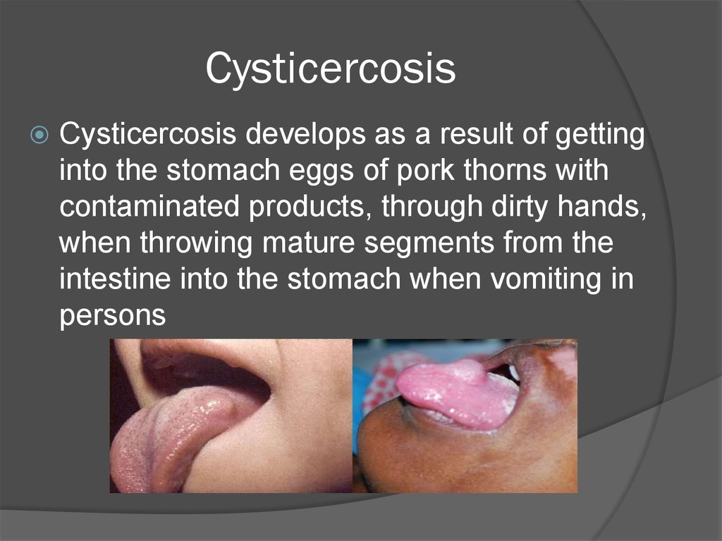 Cysticercosis