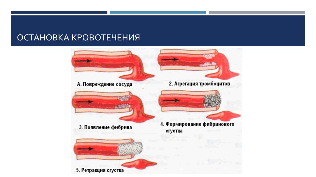 Остановка кровотечения