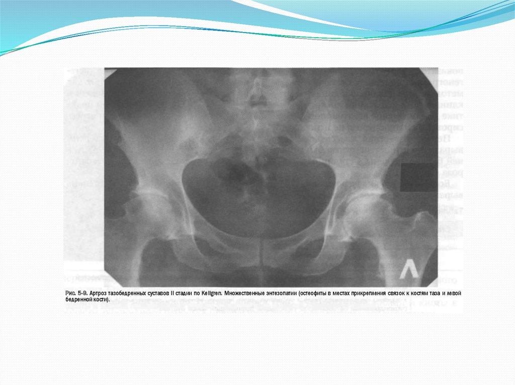 2 степень тазобедренных суставов. Энтезопатия тазобедренных суставов рентген. Доа тазобедренного сустава 2 ст рентген. Коксартроз 2 степени рентген. Доа тазобедренного сустава 3 степени рентген.