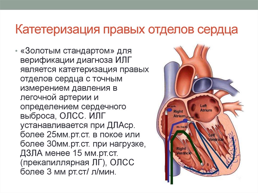 Правой отдел. Катетеризация полостей сердца методика. Катетеризация правых отделов сердца и легочной артерии. Катетеризация правых отделов сердца. Катетеризация правых отделов сердца при легочной.