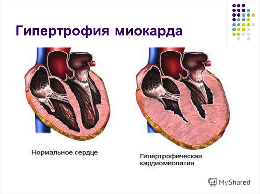 Миокард правого желудочка сердца. Гипертрофия и дилатация миокарда. Гипертрофия кардиомиопатия. Концентрическая гипертрофия левого желудочка макропрепарат. Концентрическая гипертрофия миокарда патогенез.