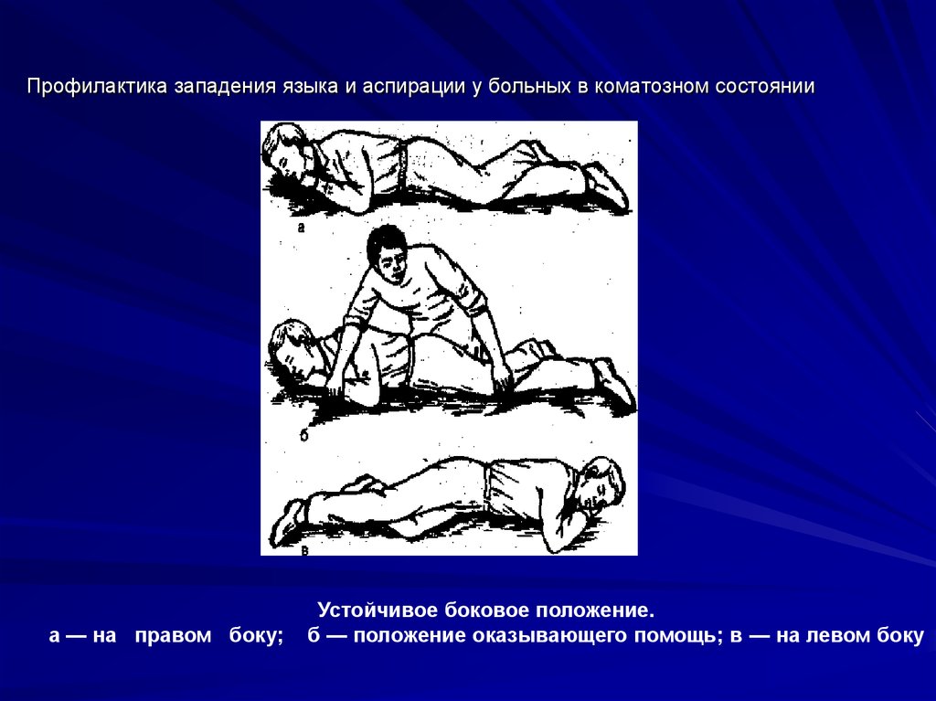 Против положение. Профилактика аспирации и западения языка.. Положение пациента в коматозном состоянии. Положение больного при коматозном состоянии. Профилактика западения языка.