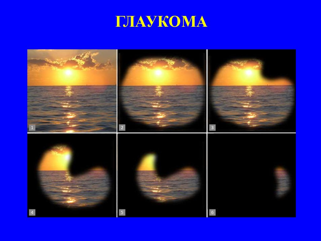 Как видит человек с глаукомой картинки
