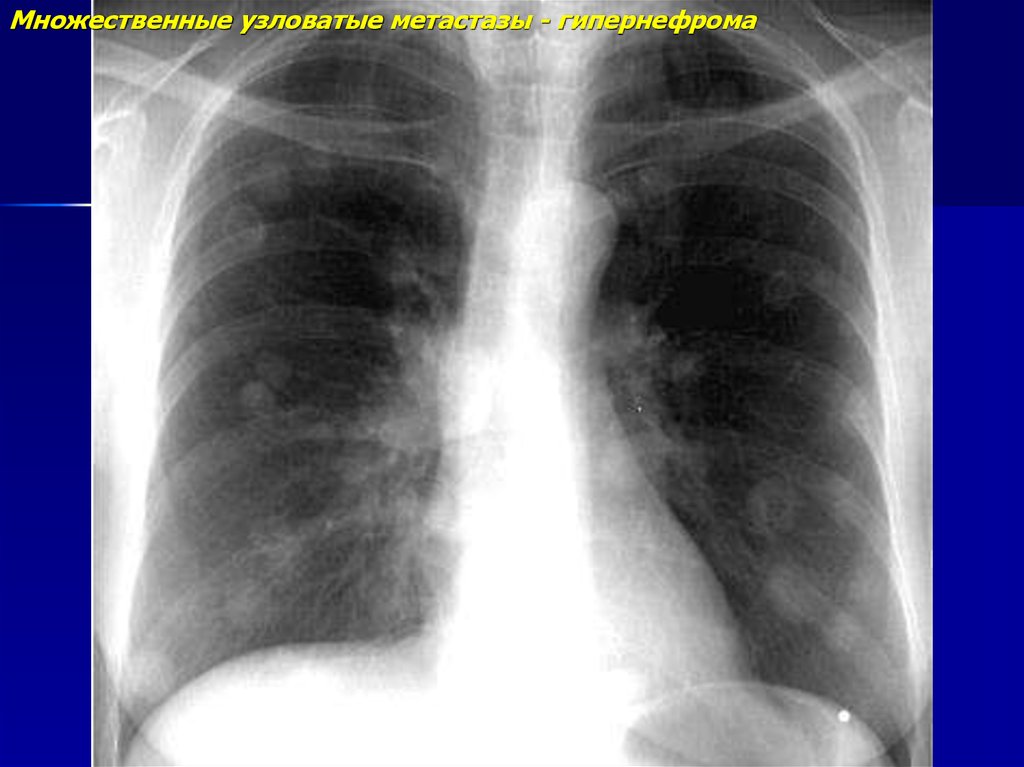 Метастазы в легких это. Метастатическое поражение легких рентген. Множественные метастазы. Множественные метастазы в легких. Солитарный метастаз в легком.