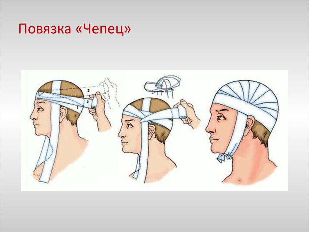 Перевязка головы схема