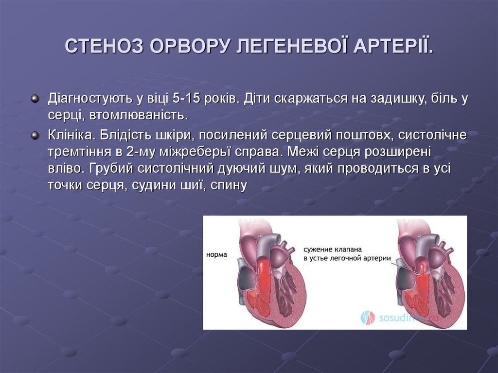 Стеноз артерий сердца. Стеноз клапана легочной артерии мкб. Степени стеноза легочной артерии. Стеноз клапана легочного ствола. Клапанный стеноз легочной артерии мкб.