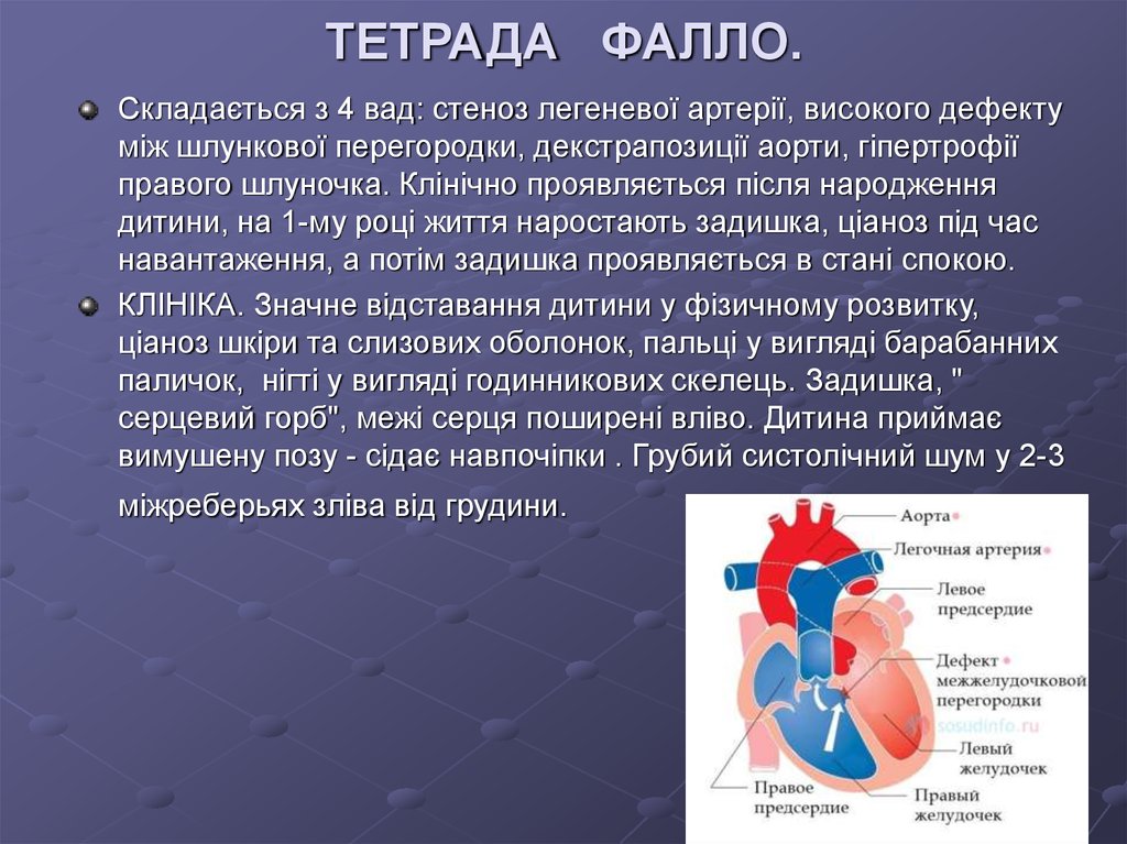 Врожденный порок сердца тетрада фалло презентация