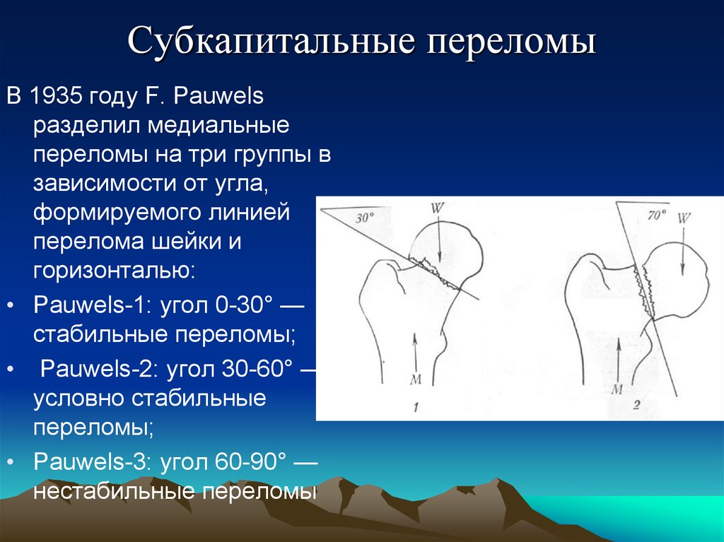 Перелом шейки бедра карта