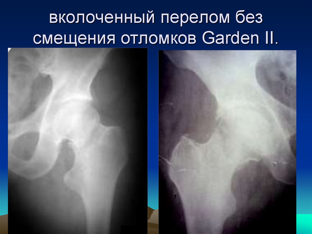 Трещина шейки. Вколоченный перелом шейки бедра рентген. Субкапитальный вколоченный перелом шейки бедра рентген. Субкапитальный перелом шейки левой бедренной кости. Вколоченный перелом шейки бедра.