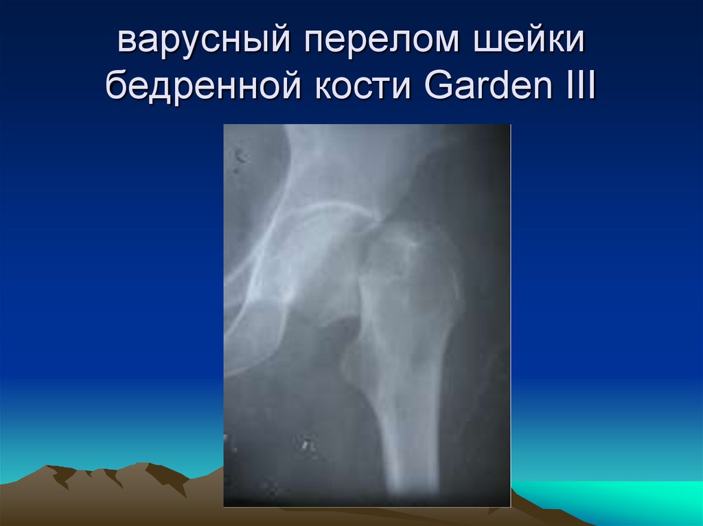 Трещина шейки. Субкапитальный перелом шейки бедра рентген. Субкапитальный перелом шейки бедренной кости. Варусный перелом шейки бедренной кости. Вколоченный перелом шейки бедра рентген.