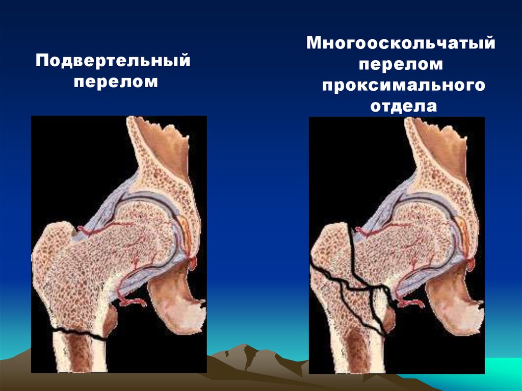 Подвертельный перелом. Подвертельные переломы. Подвертельный перелом шейки бедра. Подвертельный перелом закрытый.