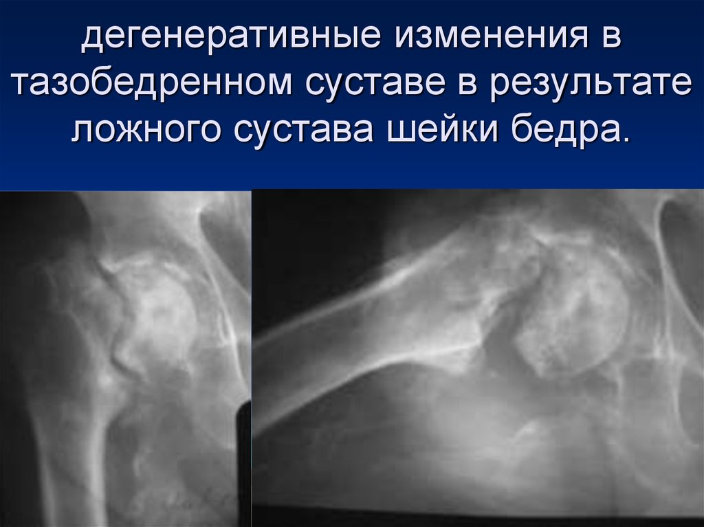 Дистрофические изменения костей. Перелом шейки тазобедренного сустава рентген. Ложный сустав перелома шейки бедра кт. Перелом тазобедренного сустава рентген. Перелом шейки бедренной кости рентген.