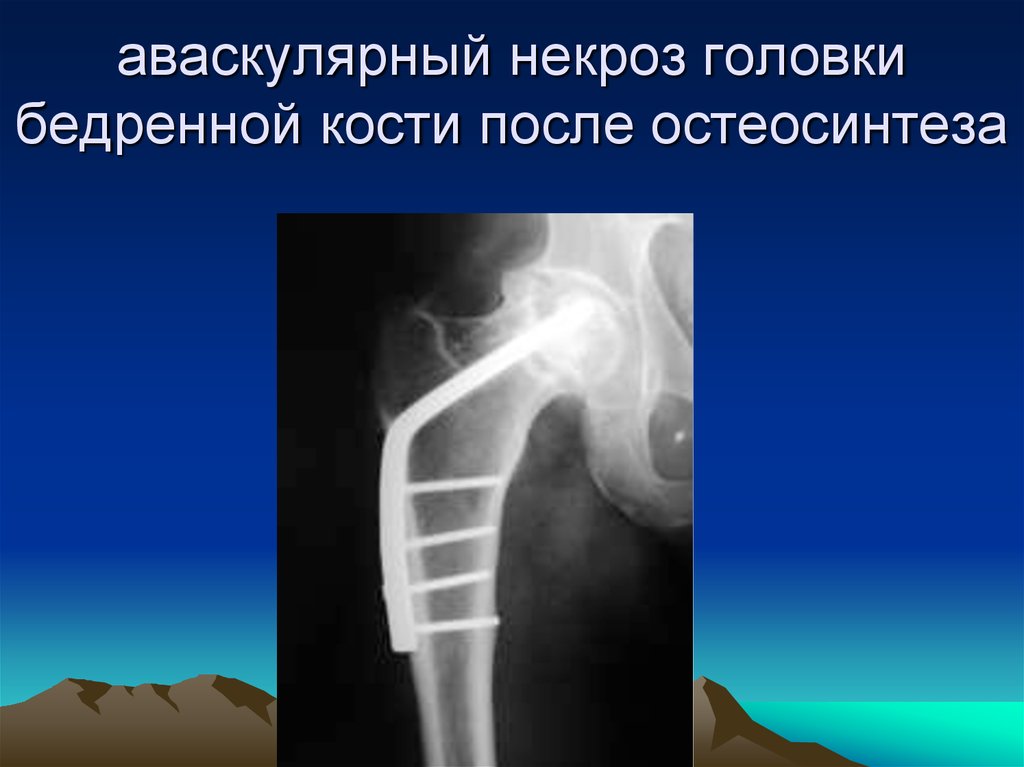Некроз шейки бедра. Асептический некроз плечевой кости рентген. Асептический некроз плечевой кости кт. Аваскулярный некроз головки бедренной кости. Аваскулярный некроз головки плечевой кости.