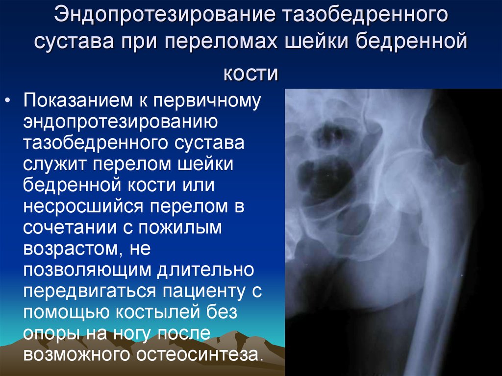 Операция при переломе шейки бедра в пожилом. Эндопротезирование тазобедренного протокол рентген. Эндопротезирование тазобедренного сустава. Перелом тазобедренного сустава. Эндопротезирование шейки бедренной кости.