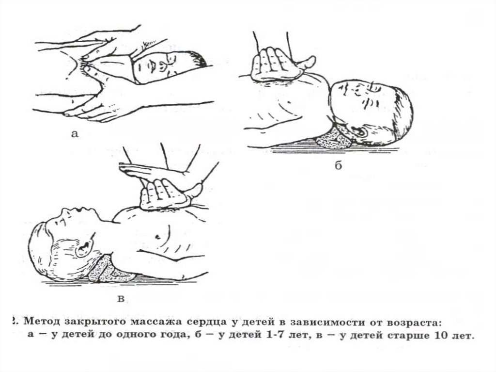 Закрытый массаж. Искусственное дыхание и непрямой массаж сердца ребенку. Детям до года непрямой массаж сердца проводится:. Непрямой массаж сердца техника выполнения у детей. Непрямой массаж сердца у детей до 1 года.
