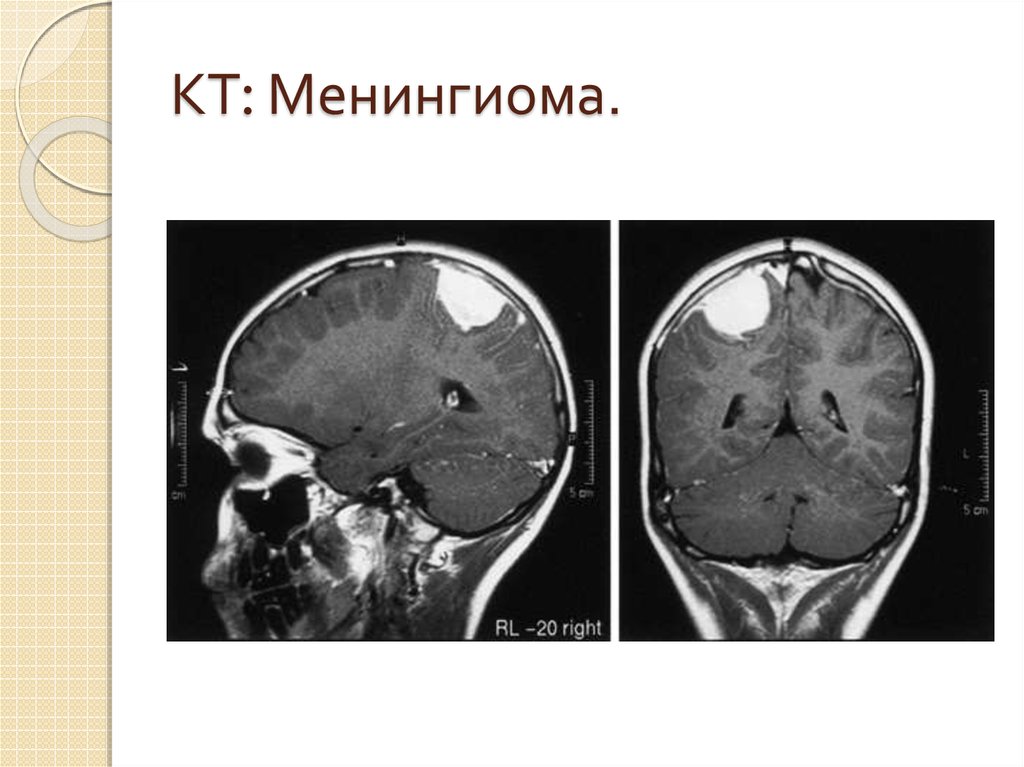 Менингиома головного. Опухоли мозга (менингиома);. Менингиомы головного мозга кт. Менингиома головного мозга кт.