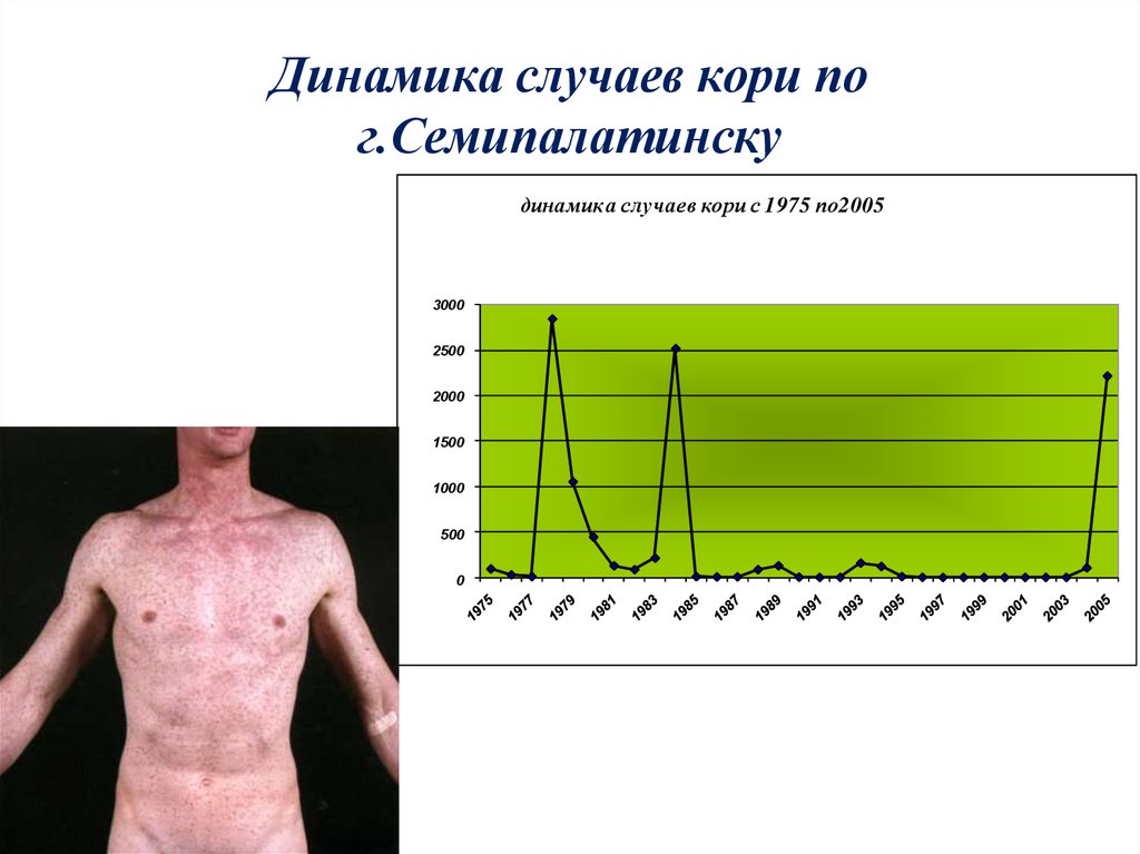 Катаральный период кори симптомы. Метод диагностики кори. Клиническая диагностика кори. Метод лабораторной диагностики кори. Диагностические критерии кори.