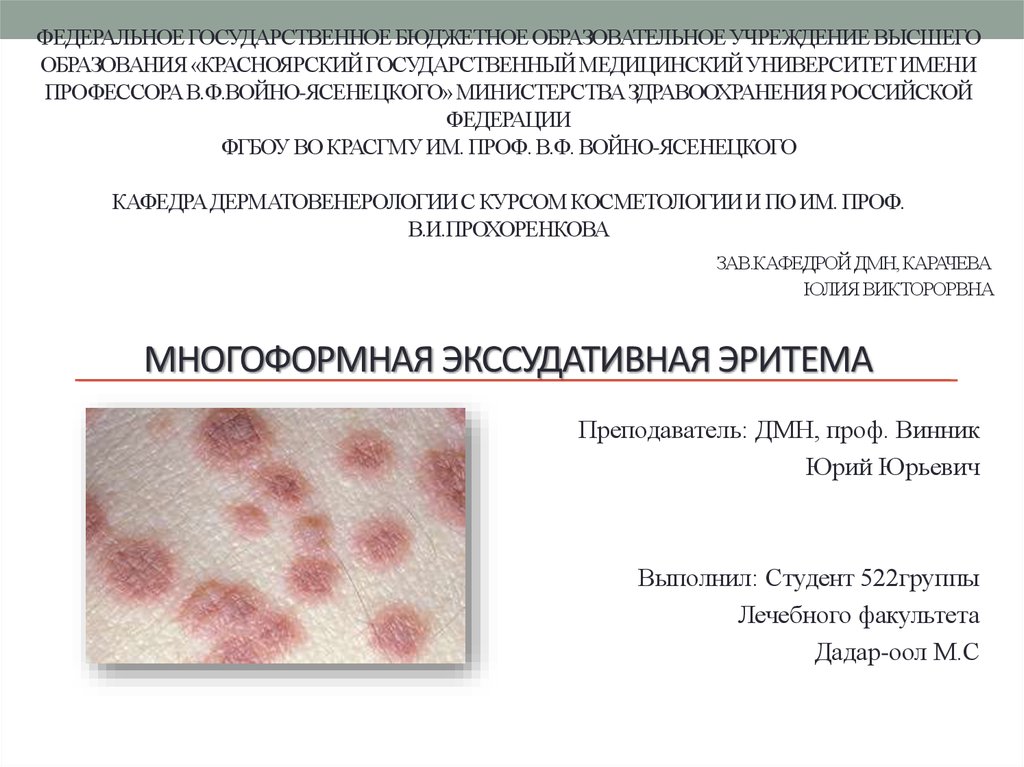 Многоформная экссудативная эритема картинки