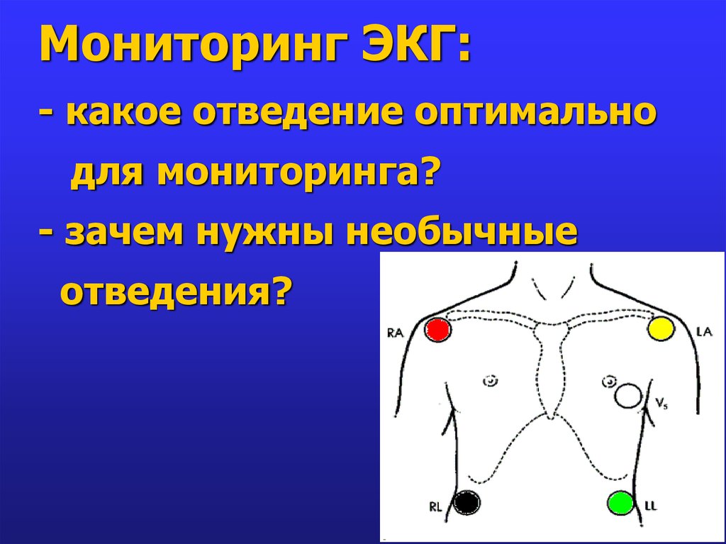 Дополнительные отведения экг презентация