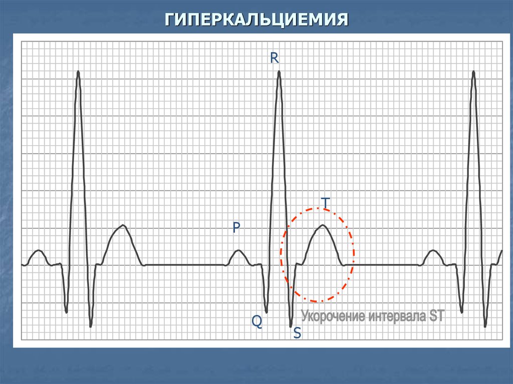 Экг при гиперкалиемии картинки