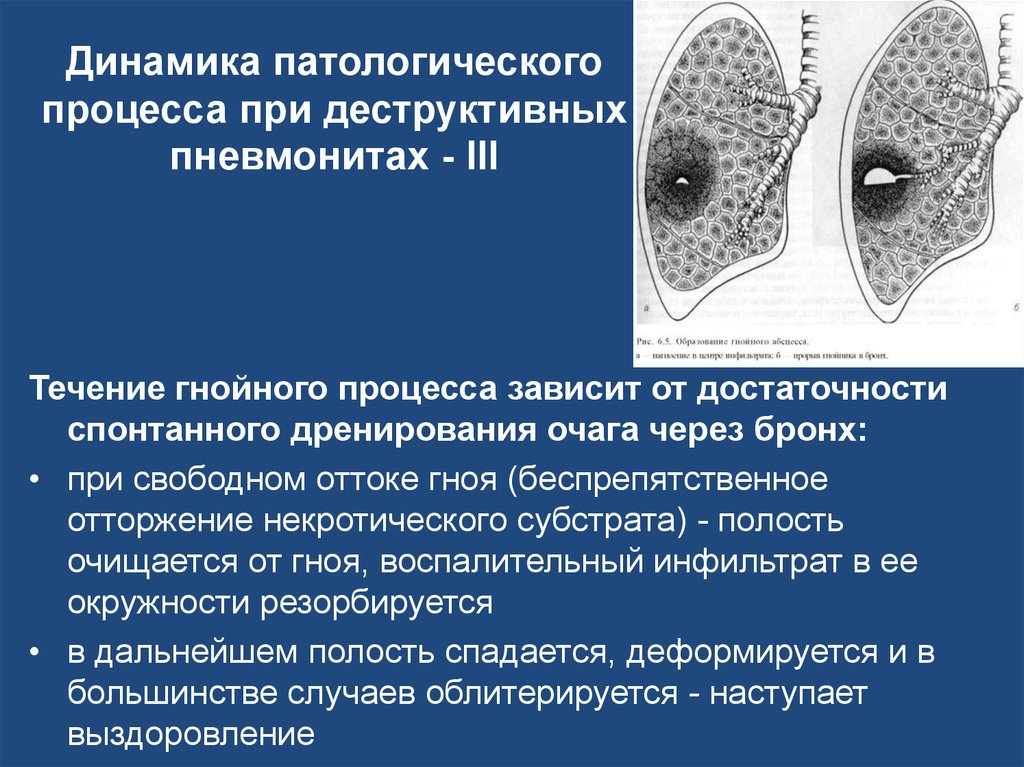 Пневмонит. Деструктивные пневмониты пропедевтика. Течение патологического процесса. Динамичность патологического процесса. Отрицательная динамика патологического процесса.