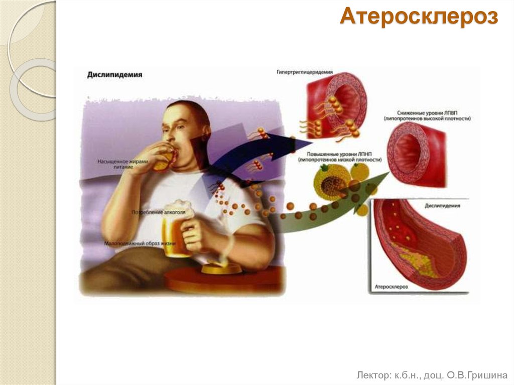 Профилактика атеросклероза. Профилактика атеросклероза сосудов. Атеросклероз презентация. Атеросклероз профилактика болезни. Для профилактики атеросклероза в питании.