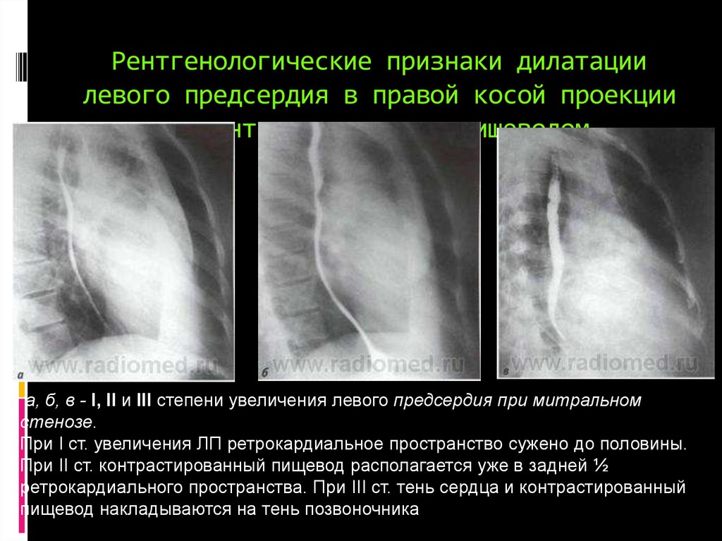 Дилатация левого. Рентгенография сердца с контрастированным пищеводом. Рентген сердца в правой косой проекции. Левая косая проекция пищевода. Рентген пищевода в косой проекции.