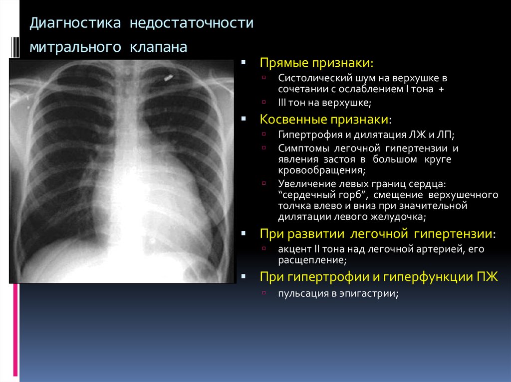 Недостаточность митрального клапана код