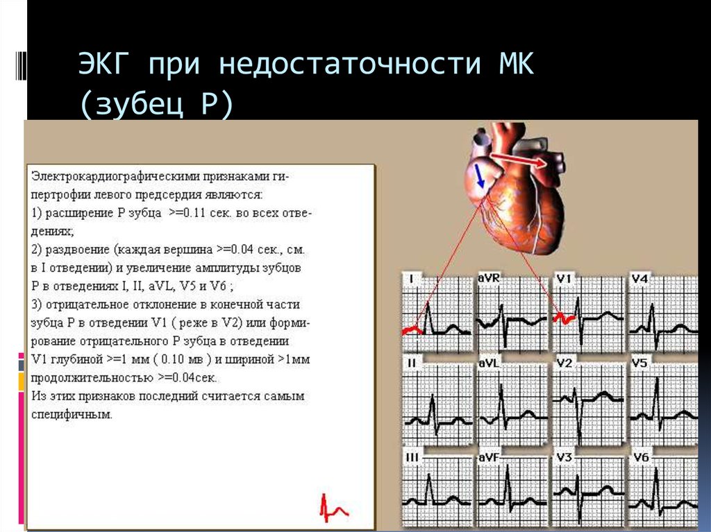 Расширение предсердий