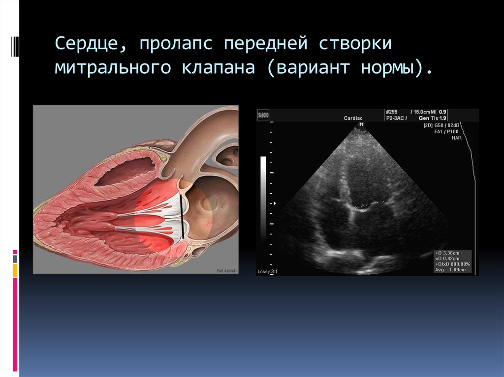 Пролапс митрального клапана категория. Пролабирование передней створки митрального клапана. Пролапс митральной створки переднего клапана. Передняя створка митрального клапана. Эхокардиография пролапс митрального клапана классификация.