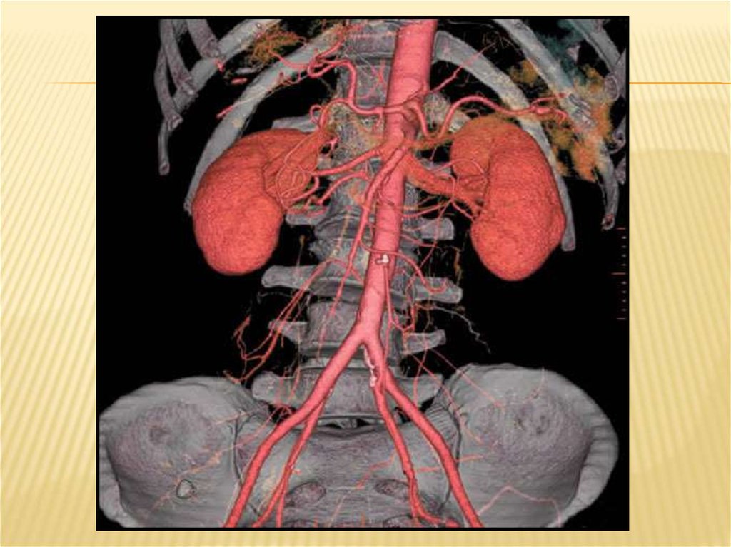 Мскт артерий. Почечная недостаточность кт. СКТ почек. Контрастирование почек кт. РКТ почек.