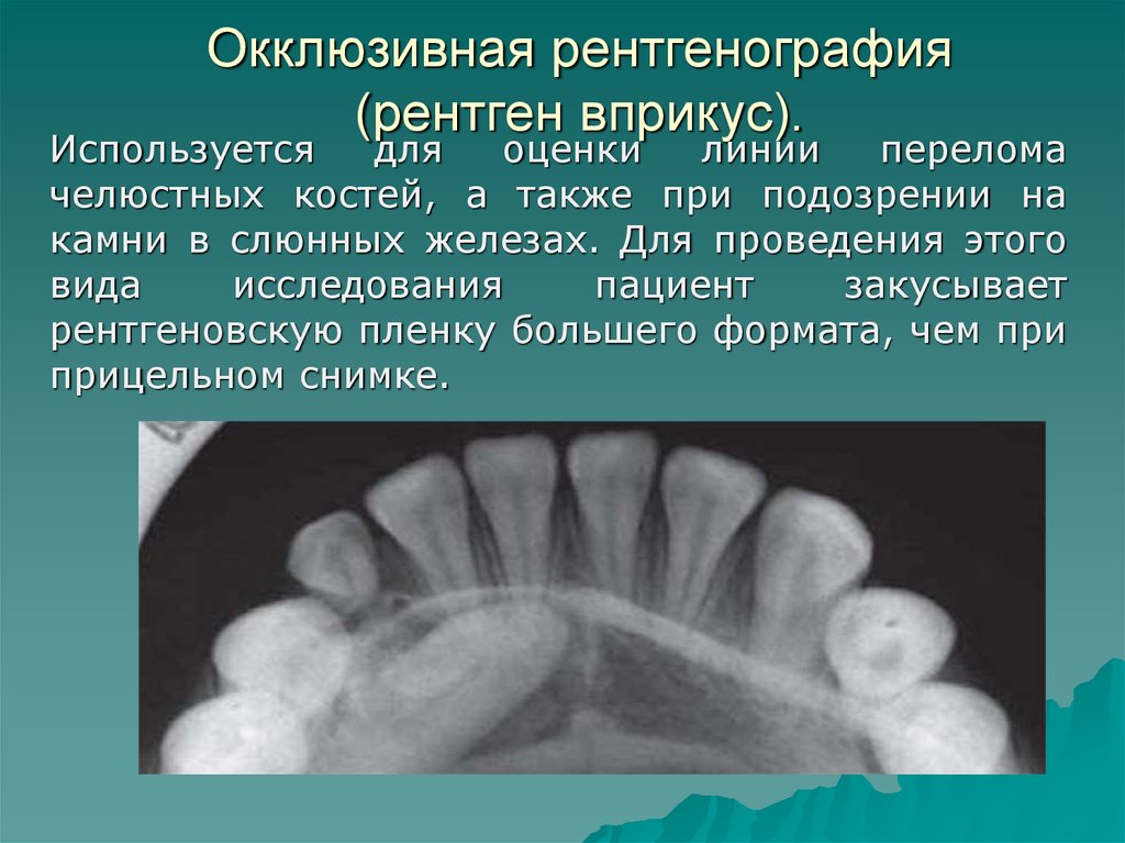 Рентгенография в стоматологии презентация