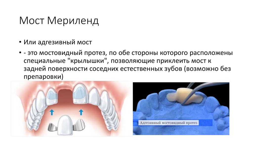 Штифтовые конструкции в ортопедической стоматологии презентация