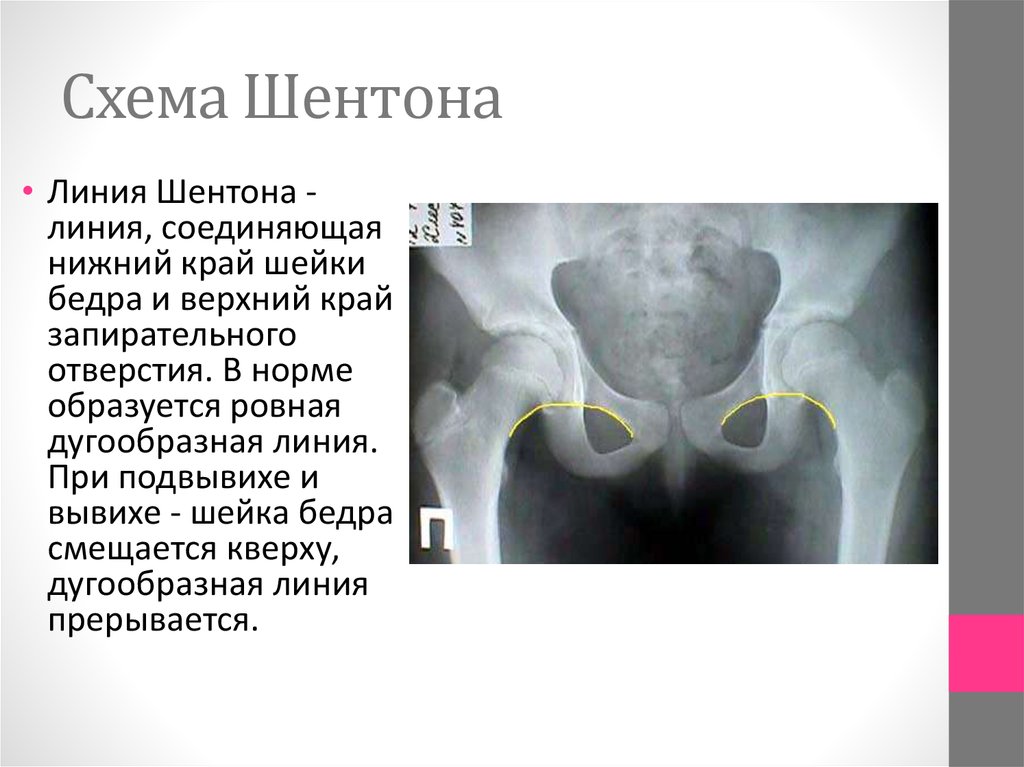 Схема врожденного вывиха бедра