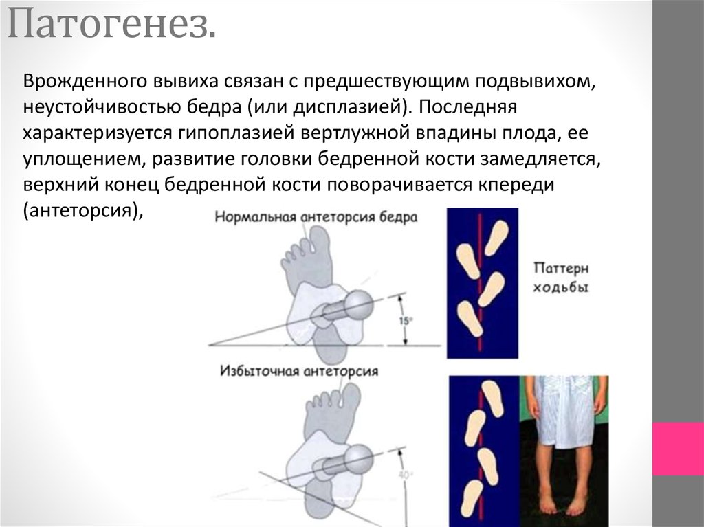 Врожденный вывих бедра. Врожденный вывих бедра этиология. Патогенез врожденного вывиха. Этиопатогенез врожденного вывиха бедра. Врожденный вывих этиология.