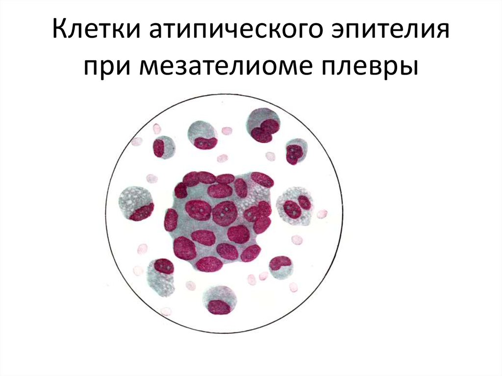Атипичные клетки в цитологии что это. Атипичные клетки в плевральной жидкости. Мазок на атипичные клетки. Атипичные клетки эпителия. Атипичные клетки в плевральной жидкости микроскопия.