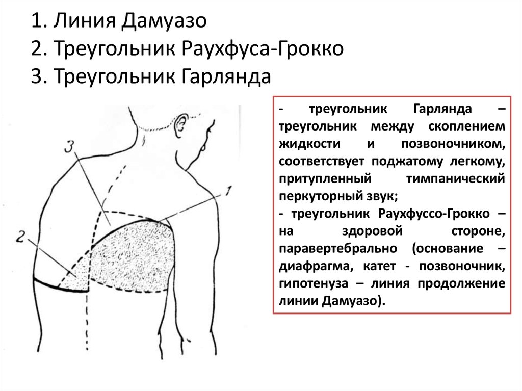 Гидроторакс карта. Эллиса Дамуазо. Пространство Траубе. Линия Дамуазо..