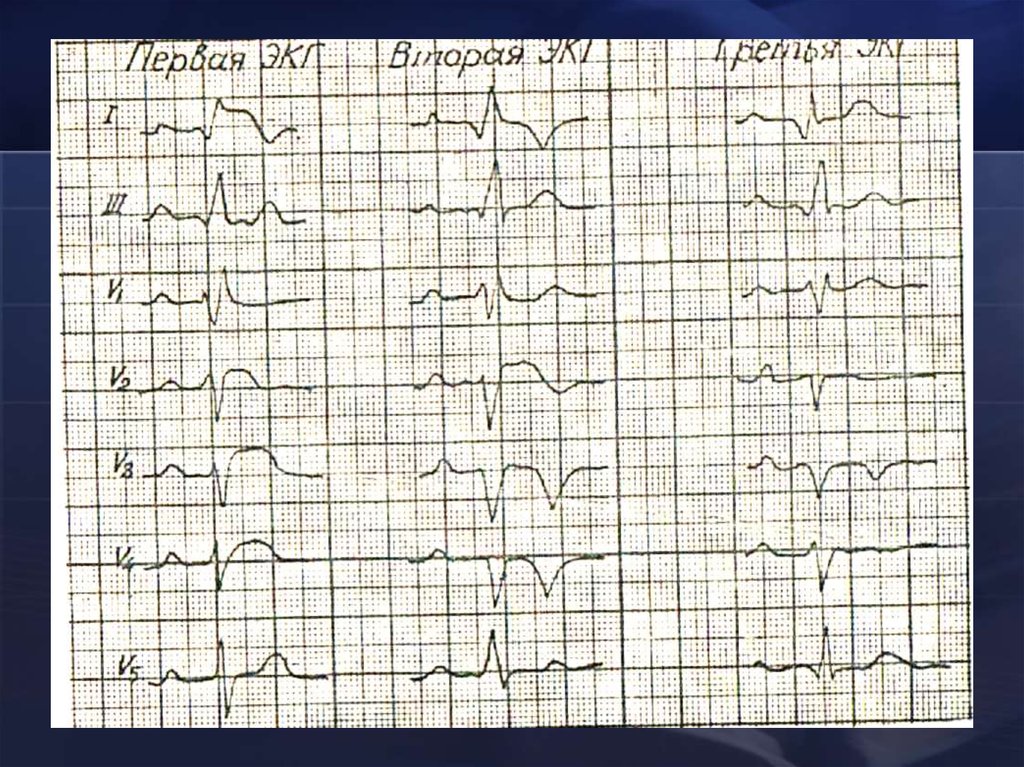 Патологический зубец q при инфаркте. СП при инфаркте миокарда. Крупноочаговый кардиосклероз на ЭКГ. Тромбоэндокардит при инфаркте. Пикс при инфаркте это.