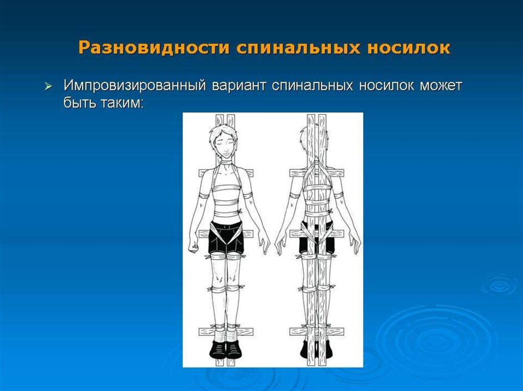 Спинальный шок презентация